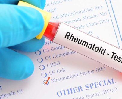 rheumatoid-factor-test